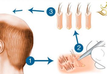 Popular questions about hair transplantation