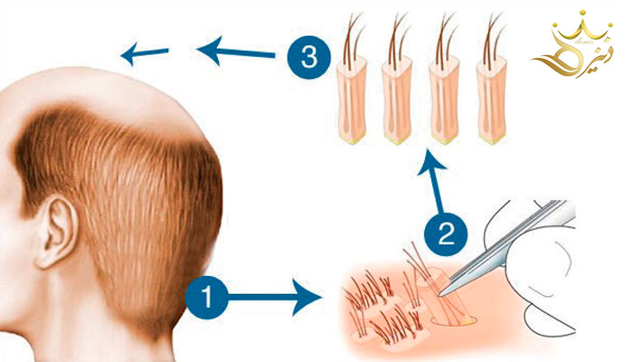 Popular questions about hair transplantation