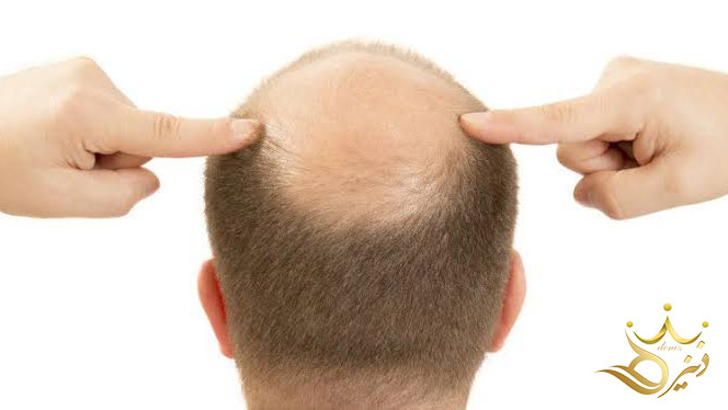 Care and things you should know after hair transplantation