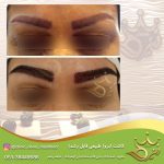 کاشت ابرو