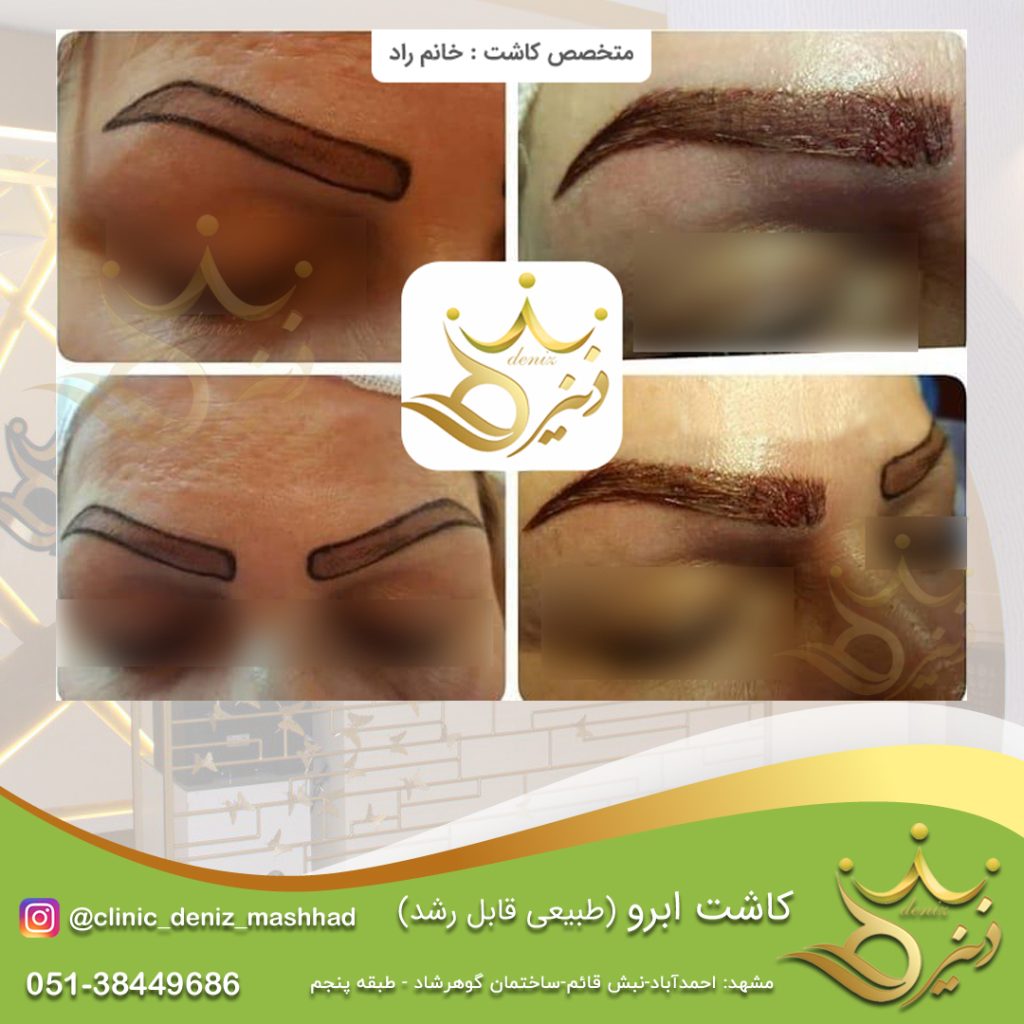 کاشت ابروی طبیعی