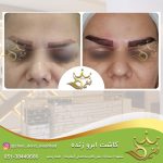 کاشت ابروی قابل رشد