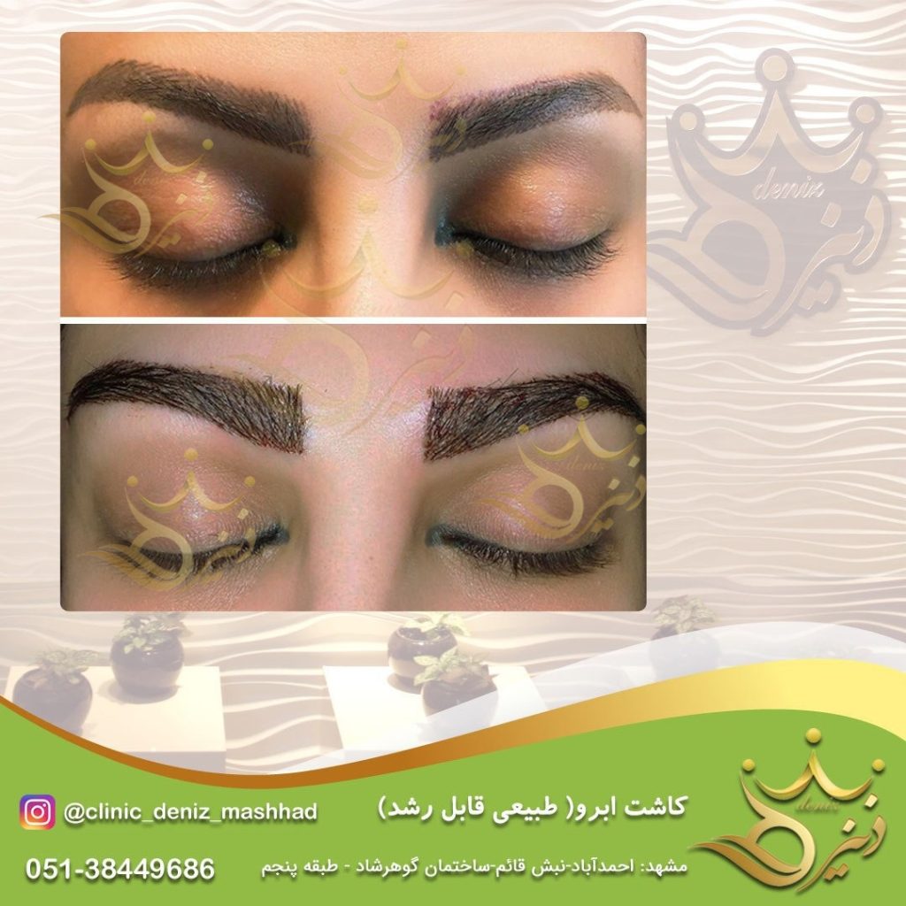 کاشت ابرو در مشهد