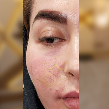 نمونه کار تزریق ژل زیر چشم خانم سرمدی