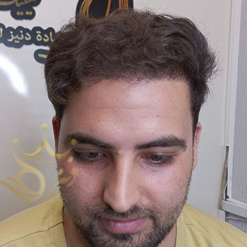 Hair transplant in Mashhad, Mr. Shariati