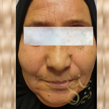 Facial fat injection in Mashhad, Ms. Kiani