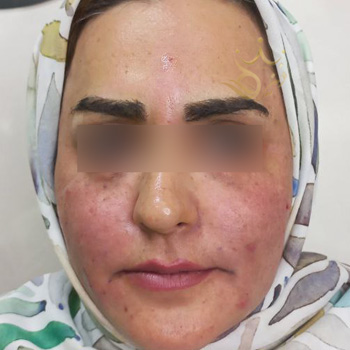 Facial fat injection in Mashhad, Ms. Haddad